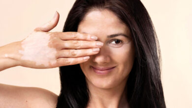 Vitiligo y psoriasis: cómo identificar las diferencias entre estas afecciones cutáneas