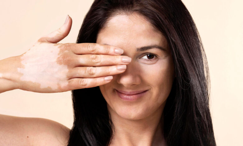 Vitiligo y psoriasis: cómo identificar las diferencias entre estas afecciones cutáneas